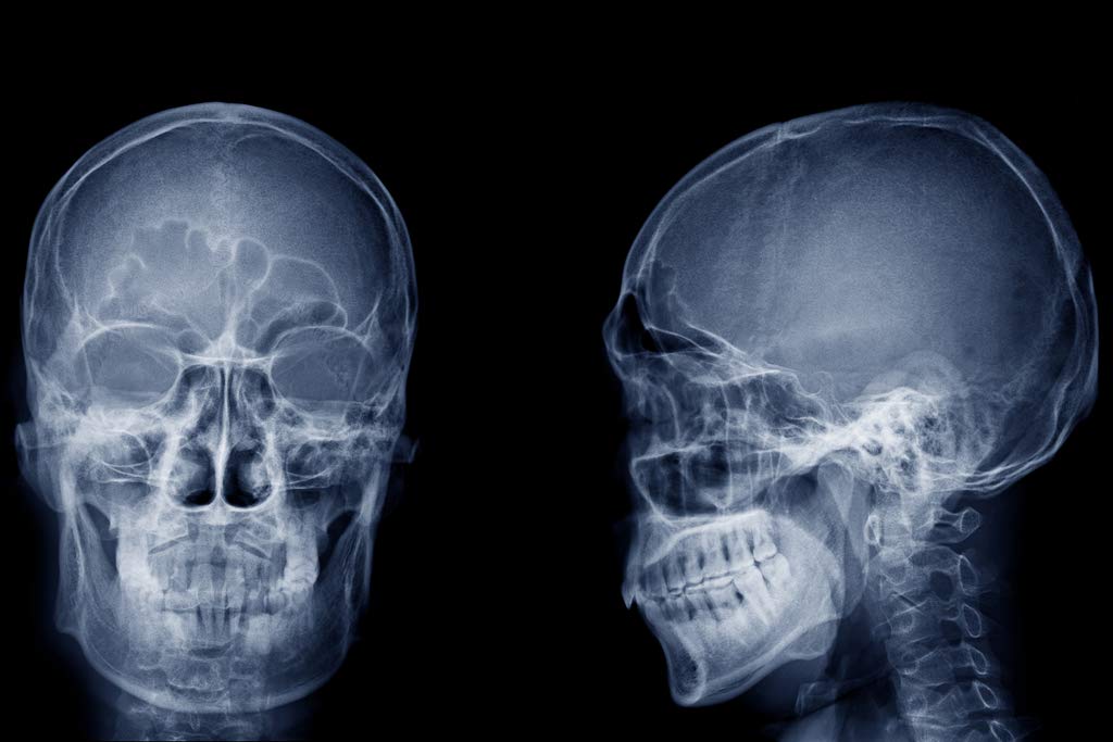 Human Skull X ray Image Front and Side Lateral View Skeleton Anatomy Medical Photo Cool Wall Decor Art Print Poster 12x18