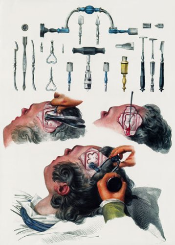 ML22 Vintage 1800's Medical Trepanning Trephining Surgical Tools & Techniques Anatomical Anatomy Poster Re-Print - A4 (297 x 210mm) 11.7" x 8.3"